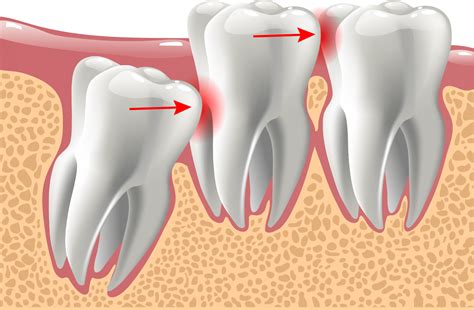 Dents De Sagesse Chirurgie Orale Cabinet Dentaire Des Savoies