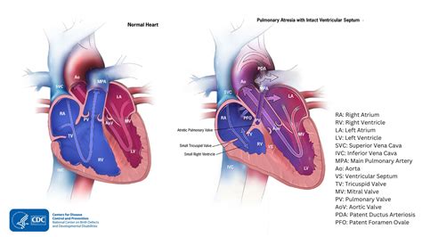 About Pulmonary Atresia | Congenital Heart Defects (CHDs) | CDC