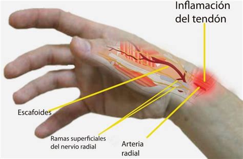 Tendinitis De Quervain Causas S Ntomas Y Tratamiento