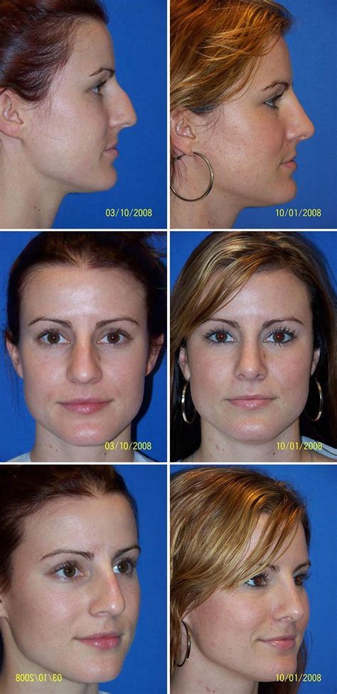 Rhinoplasty Nose Surgery Before After Photos Miami Plastic Surgery