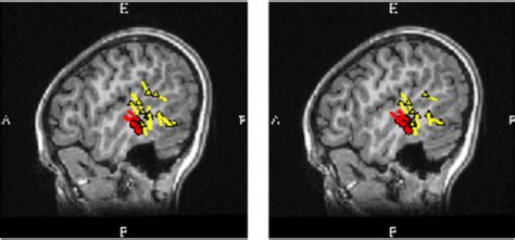 Magnetoencephalography Images Yellow Arrows Indicate Interictal