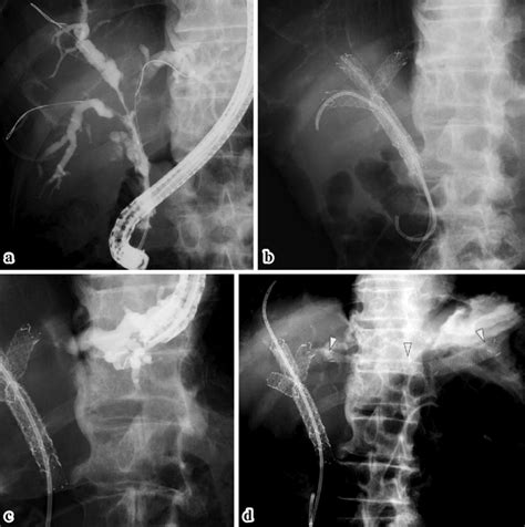 Figure2case Of Hilar Cholangiocarcinoma Patient 7 In Table 1