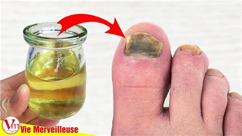 Comment Enlever Les Mycoses Des Ongles Des Pieds Rapidement Et