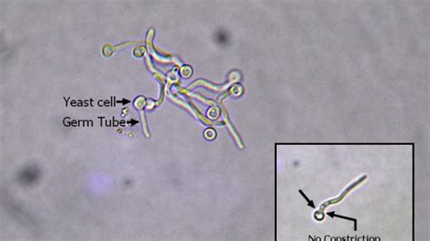 Candida Albicans Morphology Pathogenesis Clinical Manifestations Diagnosis Treatment