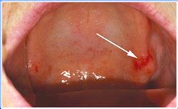 Leukoplakia Erythroplakia Smiles For Life Oral Health