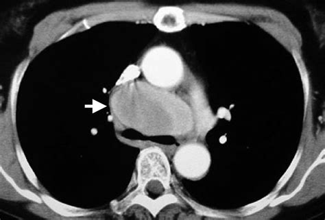 Computed tomography (CT) scan of the chest showing a... | Download ...