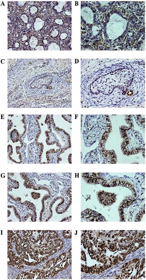 Immunohistochemical Staining Of Pax8 In Ovarian Tumors A Pax8 Positive