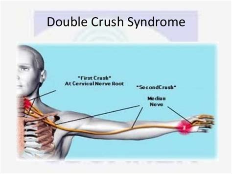 Nerve Compression Syndrome