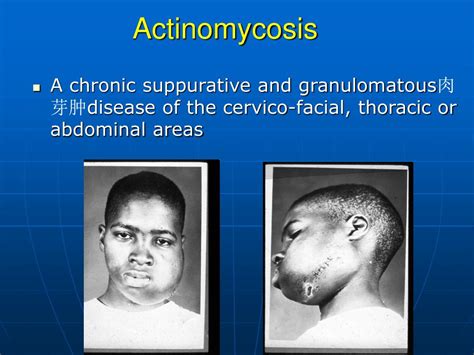 PPT - Actinomyces & Nocardia PowerPoint Presentation, free download - ID:464498