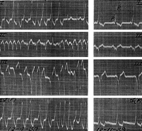 Four Leads Showing Irregular Rhythm With Wide And Narrow Qrs Complexes Download Scientific