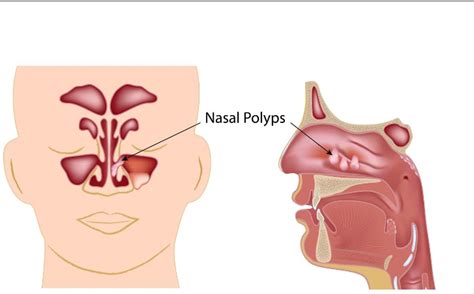 Bleeding Polyp Of The Nose Dr Mukesh Ramani