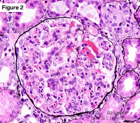 Psagn Post Streptococcal Acute Glomerulonephritis Case