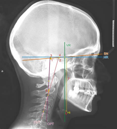 Craniocervical And Hyoid Measurements Cvt Cervical Vertebra Tangent Download Scientific