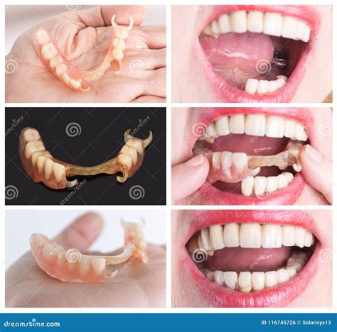 Dental Rehabilitation with Upper and Lower Prosthesis, before and after Treatment Stock Photo ...