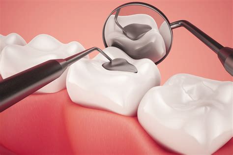 Bisfenol A Em Materiais De Obturação E Prevenção Dentária Dentablog