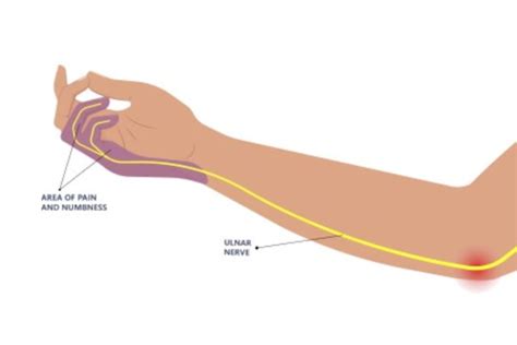 Ulnar Nerve Entrapment At The Elbow Cubital Tunnel Syndrome Ulnar Nerve Entrapment Mi Uk