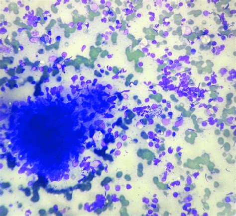 Giemsa Stain 40 X Photomicrograph Showing Well Formed Epithelioid Cell