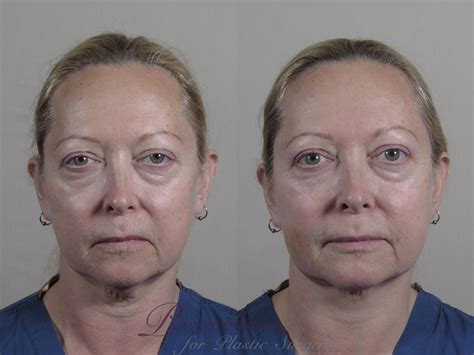 Nonsurgical Face Procedures Before And After Pictures Case 986 Paramus Nj Parker Center For