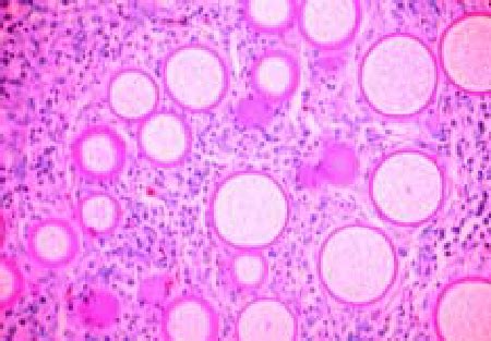 Histology Of Rhinosporidiosis A Formalde Hyde Fixed Section Of Human