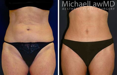 Reverse Upper Modified Lower Abdominoplasty Photo Gallery Page 1 Of 1