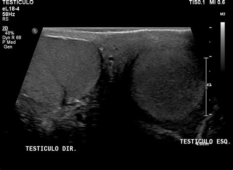 Testicular Torsion Image