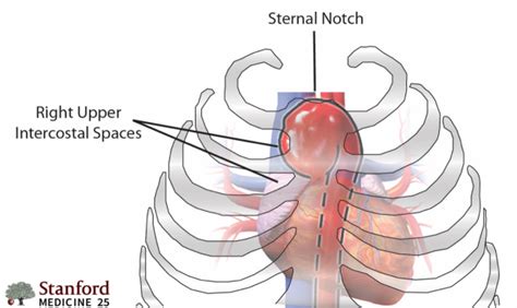 Aortic Regurgitation Exam Stanford Medicine 25 Stanford Medicine