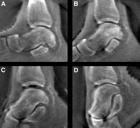 Maximum Ankle Plantarflexion And Dorsiflexion Allow For Optimal