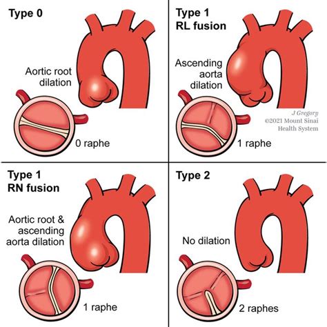 Anatomical Classification For Bicuspid Aortic Valves Abbreviations