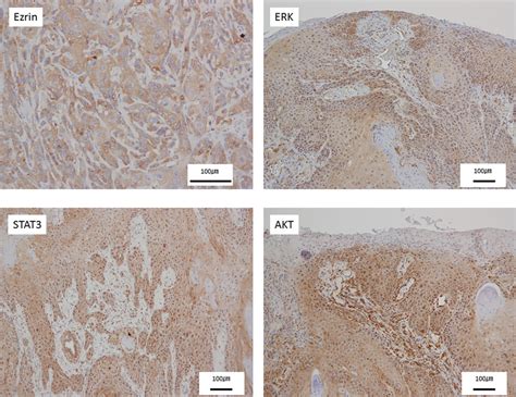 Ezrin Erk Stat And Aktstained Images Of Human Tongue Cancer