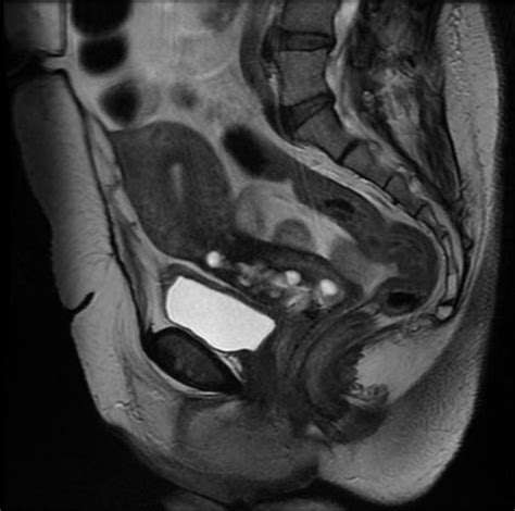 Nabothian cyst - wikidoc