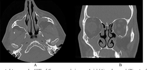 Figure 1 From Bilateral Silent Sinus Syndrome A Rare Case And Review Of Literature Semantic