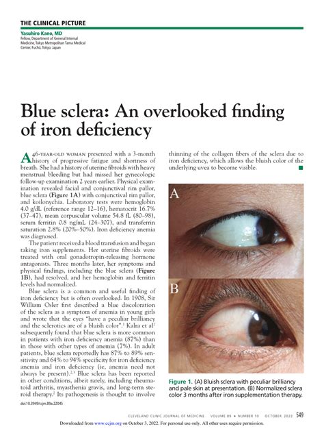 Pdf Blue Sclera An Overlooked Finding Of Iron Deficiency