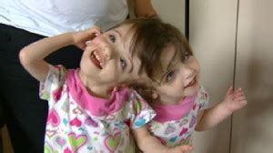 Chinese Conjoined Twins: One Body, Two Heads Video - ABC News