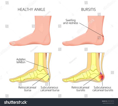 Subcutaneous Calcaneal Bursitis