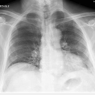 Anterior Posterior Chest Radiograph Showing No Acute Cardiopulmonary