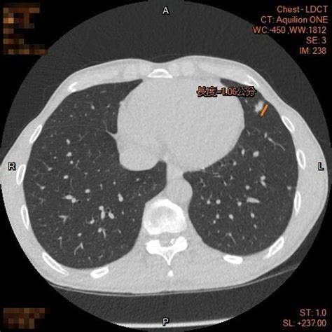 肺癌篩檢發現 不抽菸罹患肺癌 家族病史是主因 自由健康網