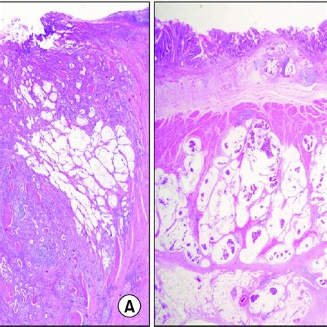 Extracellular Mucin Pools Are Lower Than One Half Of The Tumor Area A