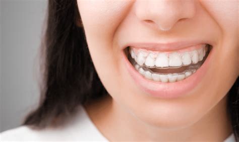 Ceramic Clear Braces Pros And Cons