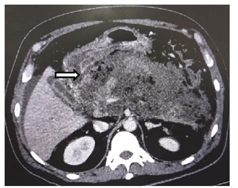 Axial Image From Cect Scan Acquired From A Patient Of Acute Necrotizing Download Scientific