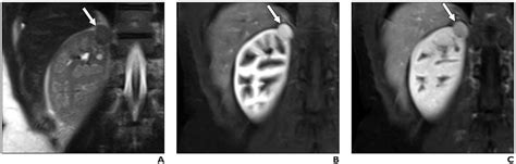 Figure 1 From Role Of Virtual Biopsy In The Management Of Renal Masses