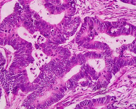 Adenocarcinoma Invasivo E Ulcerado BRAINCP