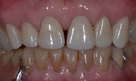 Before And After Dental Crowns Brisbane Edward St Dental