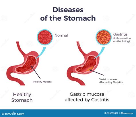 Gastritis Stomach Set Stock Vector Illustration Of Inflammation