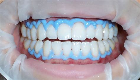 Tipos de blanqueamiento dental Guía completa para una sonrisa más