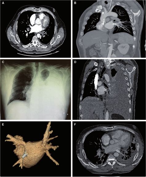 A Severe Left Lower Pulmonary Vein Pv Stenosis White Arrow B