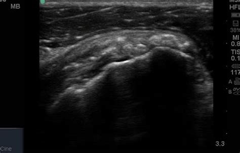 Shoulder Ultrasound Anatomy