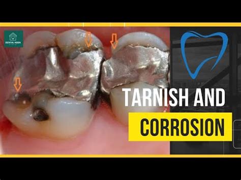 Tarnish And Corrosion Dental Materials Dentaladdadrswarneet Youtube