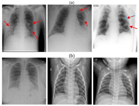 Viral Pneumonia