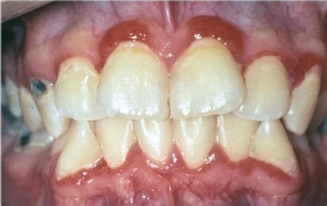 Periodontology Week 3 Ch 5 Periodontal Health Gingival Diseases And