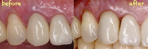 Canine Replacement With Dental Implant With Partial Extraction Therapy